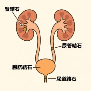 尿路結石の図解