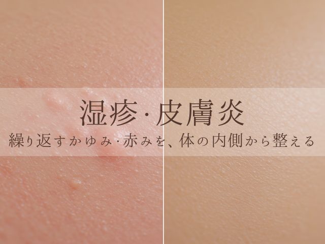 湿疹・皮膚炎 繰り返すかゆみ・赤みを、体の内側から整える